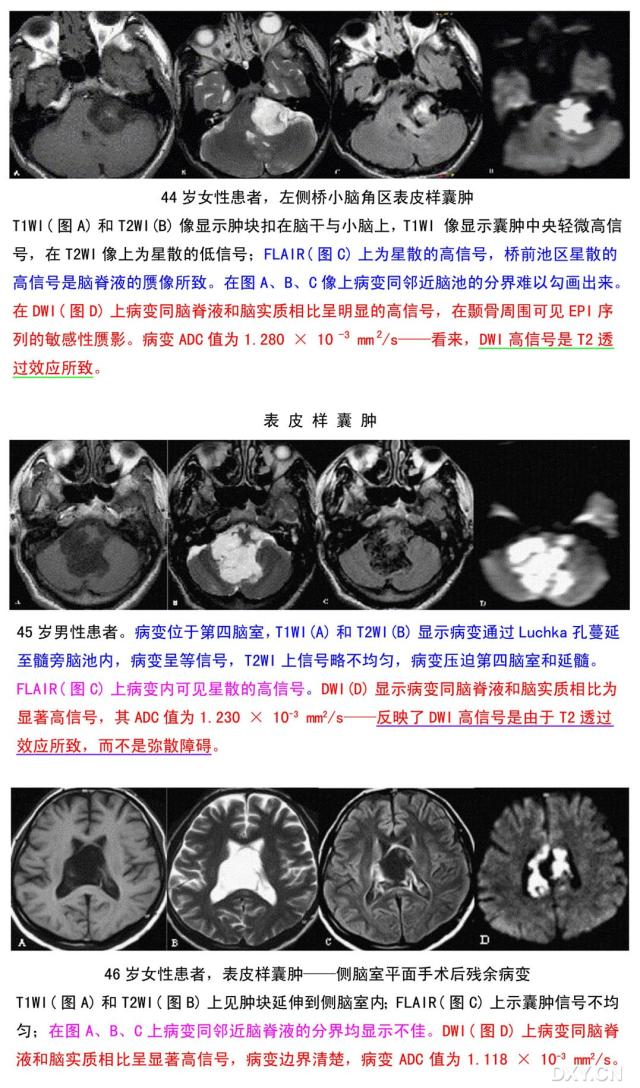 2,表皮样囊肿病例