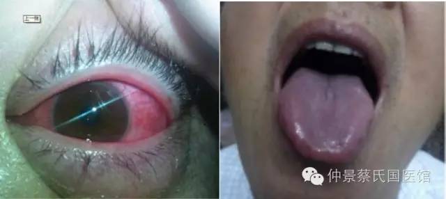 葛根汤治急性结膜炎病案--期权论坛 - 国内最专业的期权社区 葛根汤治急性结膜炎病案--期权论坛 - 国内最专业的期权社区