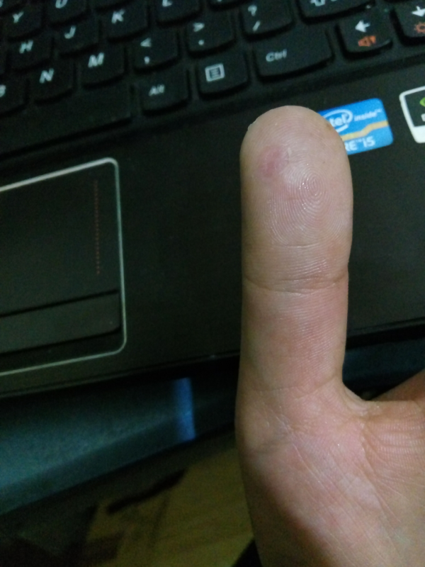 治疗手指上的寻常疣鱼鳞痣有什么办法或者药物