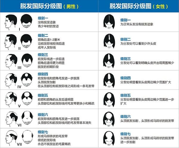 21岁脱发严重,想要织法补法或者植发,请有相关经历的人士指导或者分析